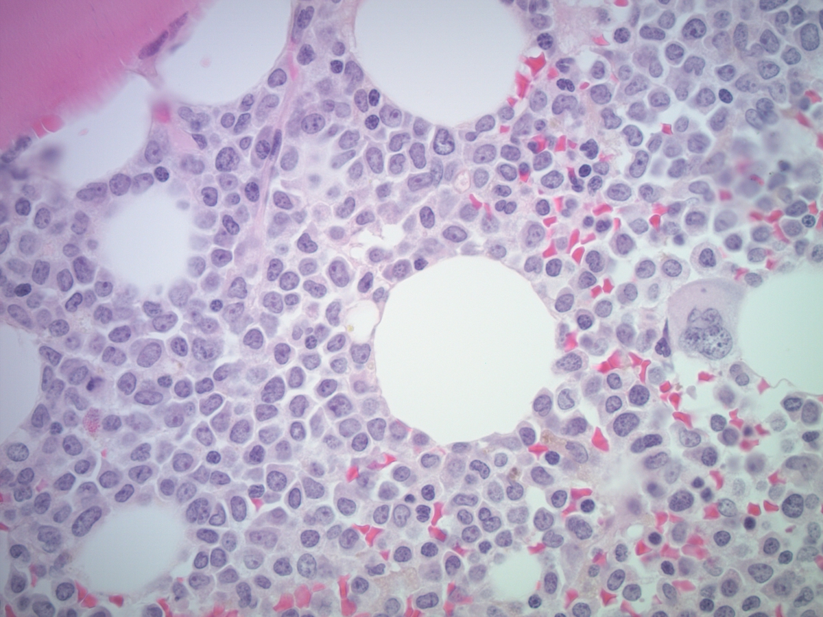 BM biopsy showing increased immature cells and blasts in sheets